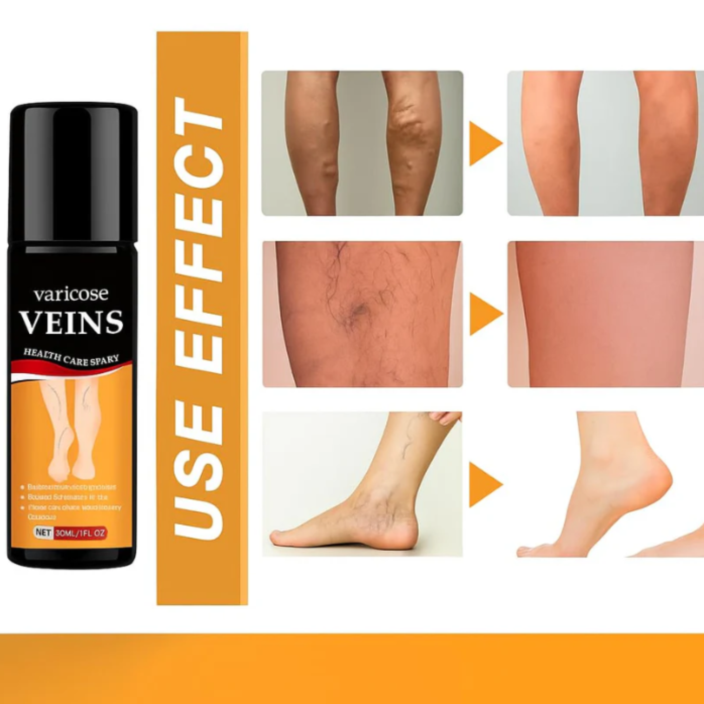 Advanced AI Varicose Veins Health Care Spray (Pack of 2)
